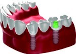 Brak kilku zębów - most na implantach